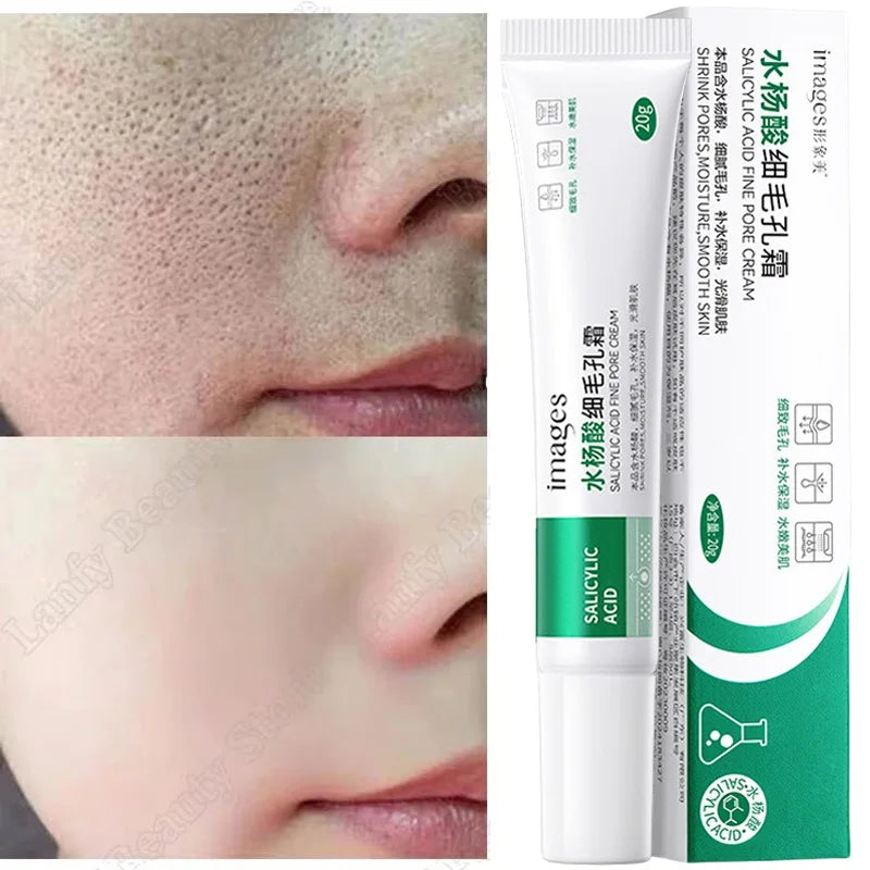 Salicylic Acid Pore Clearing Cream – Acne & Brightening Care