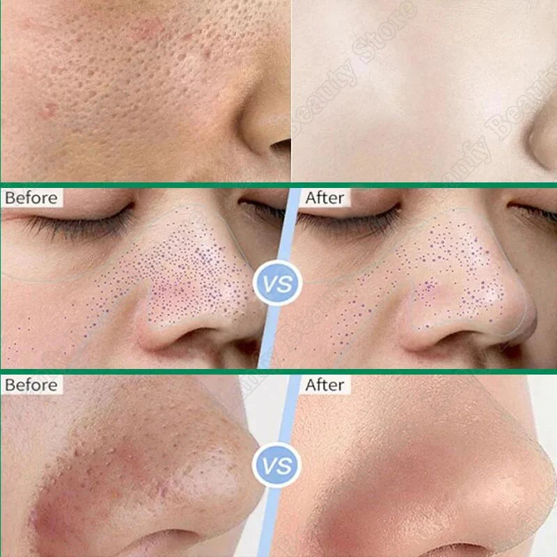 Salicylic Acid Pore Clearing Cream – Acne & Brightening Care