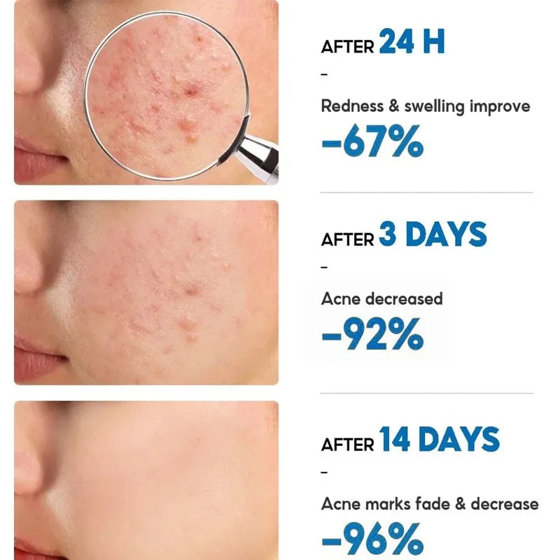 Salicylic Acid Acne Cream – Anti-Acne Repair & Pore Cleansing Skincare