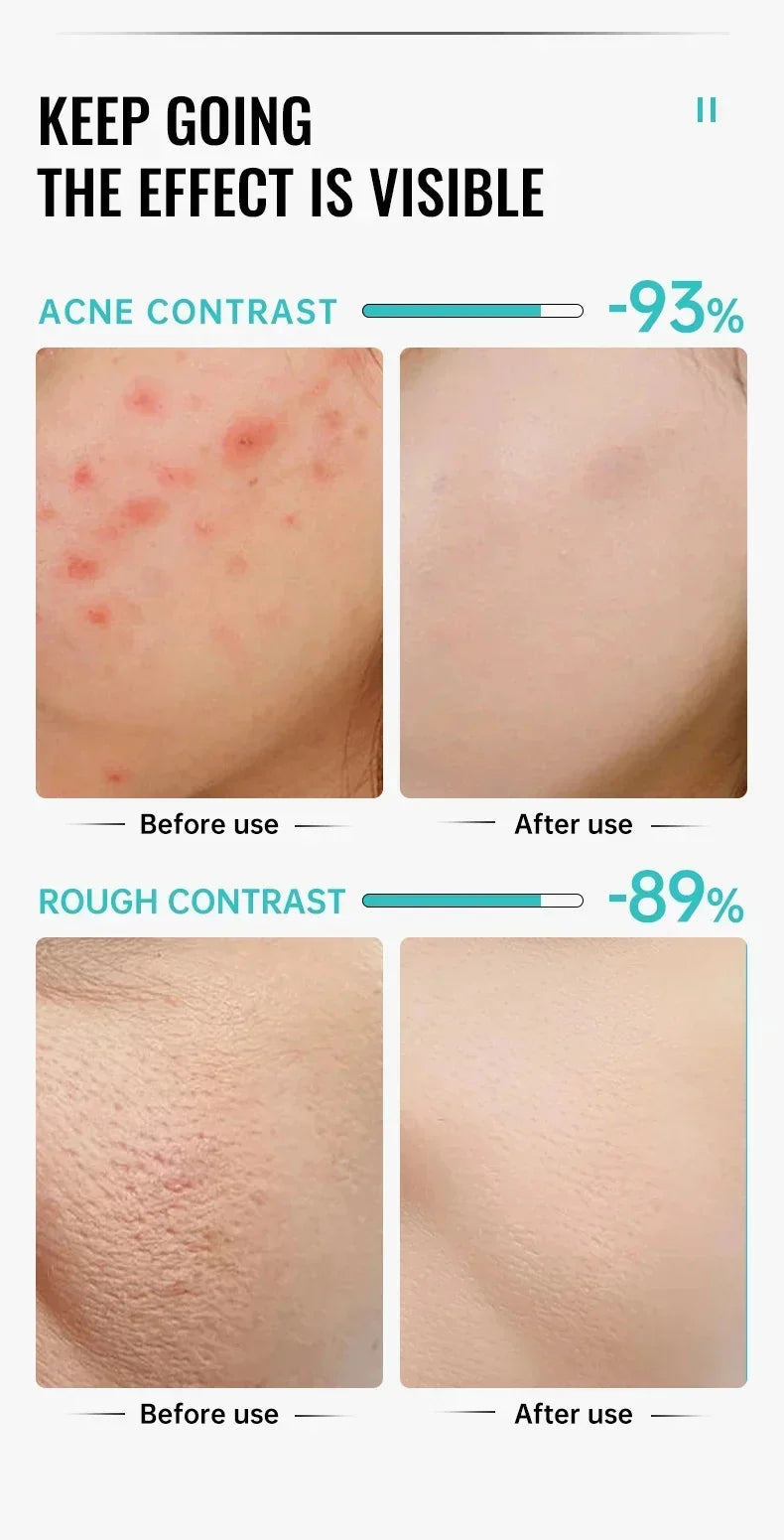 Salicylic Acid Acne Cream – Anti-Acne Repair & Pore Cleansing Skincare