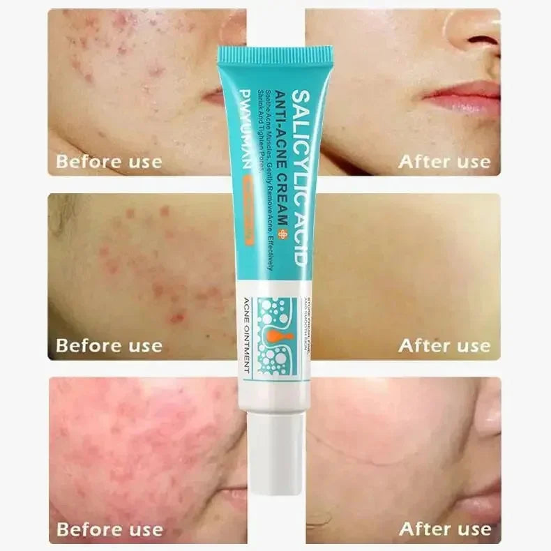 Salicylic Acid Acne Cream – Anti-Acne Repair & Pore Cleansing Skincare