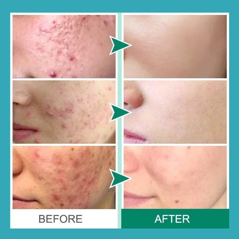 Salicylic Acid Acne Cream – Anti-Acne Repair & Pore Cleansing Skincare