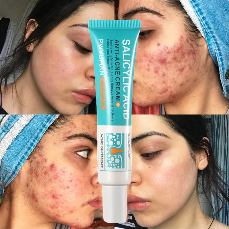 Salicylic Acid Acne Cream – Anti-Acne Repair & Pore Cleansing Skincare