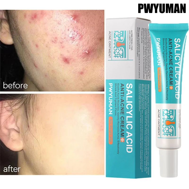 Salicylic Acid Acne Cream – Anti-Acne Repair & Pore Cleansing Skincare