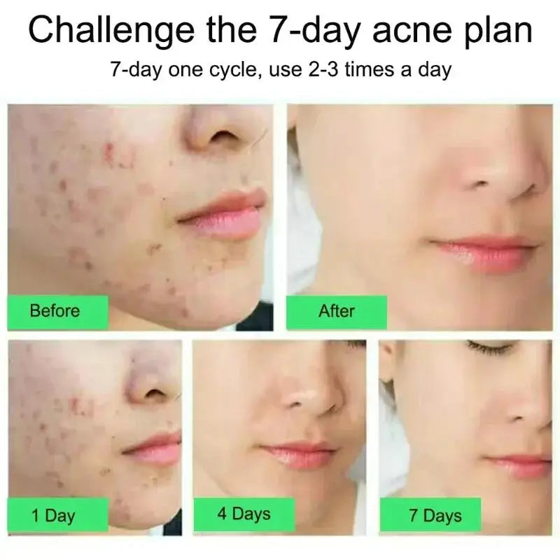 Salicylic Acid Acne Cream – Anti-Acne Repair & Pore Cleansing Skincare