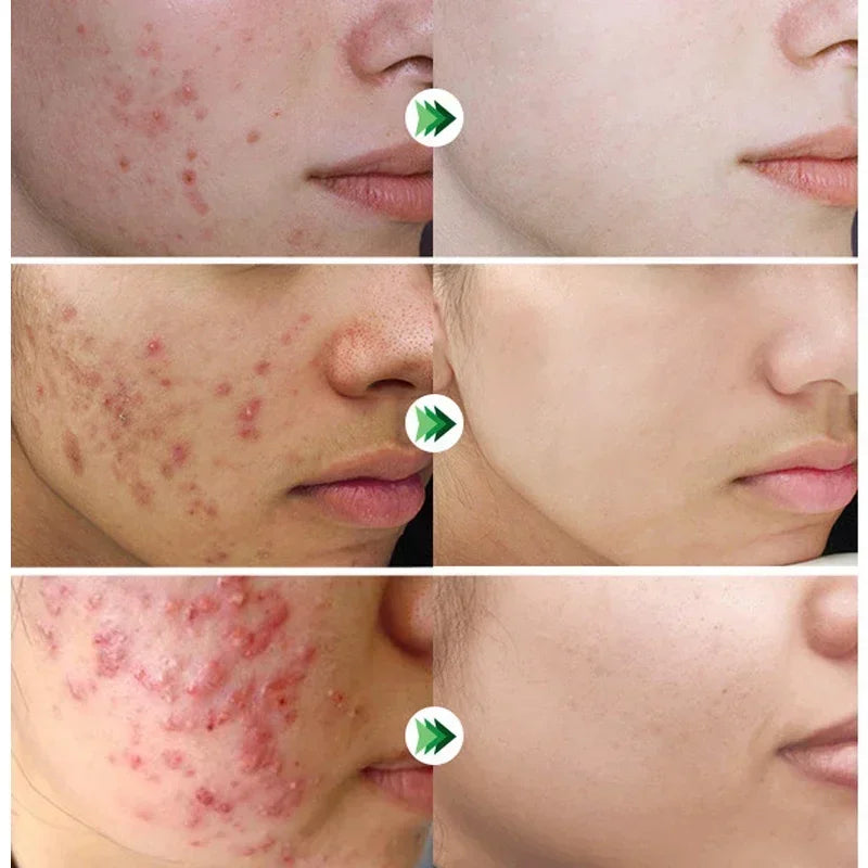 Salicylic Acid Acne Cream – Anti-Acne Repair & Pore Cleansing Skincare