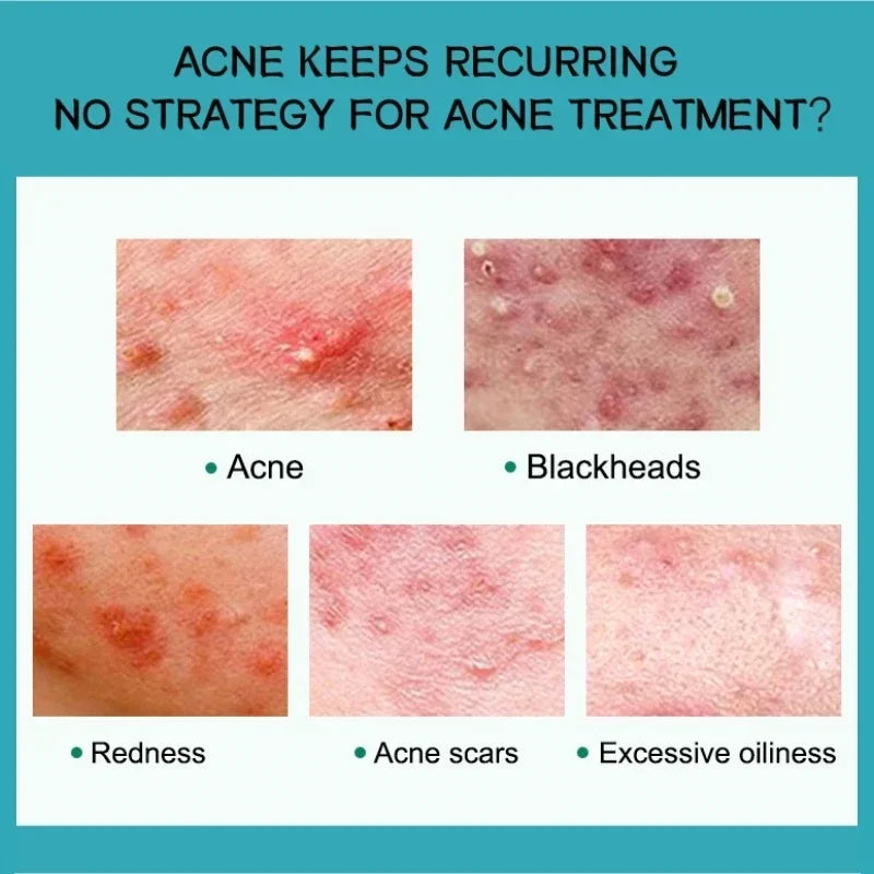 Salicylic Acid Acne Cream – Anti-Acne Repair & Pore Cleansing Skincare