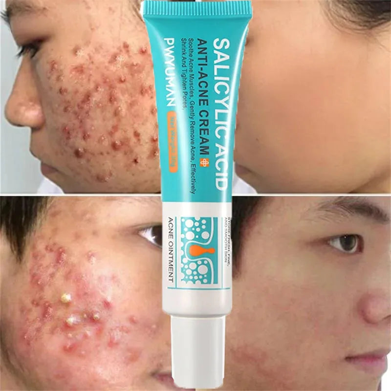 Salicylic Acid Acne Cream – Anti-Acne Repair & Pore Cleansing Skincare